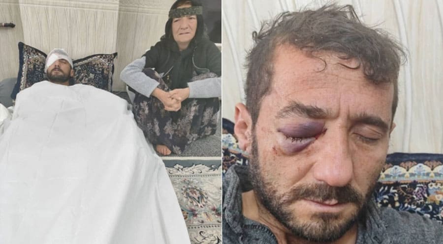 کۆلبەرێ کو ژ ئالیێ ھێزێن ئیرانێ ڤە ھاتیە بریندار کرن، چاڤێ خوە ژ دەست دا